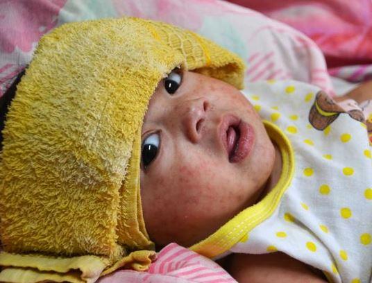 Texas measles total tops 600 cases

New Mexico and Oklahoma, two states with Texas-related spread, also reported a few more cases.

cidrap.umn.edu/measles/texas-…

Photo: CDC / Molly Kurnit, MPH