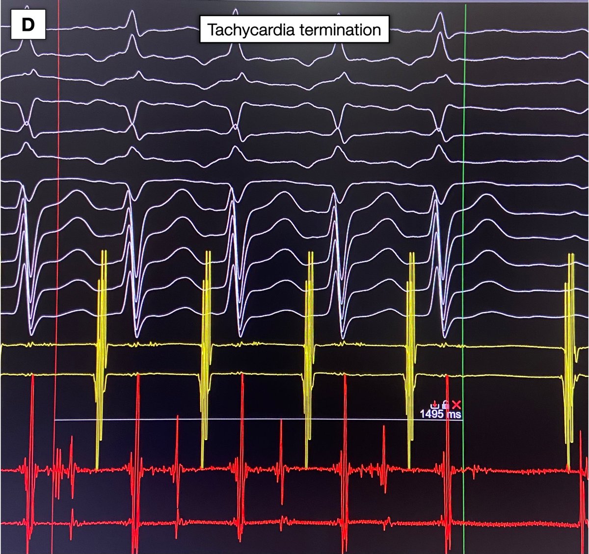JAldereteM's tweet photo. C) The AP potential precedes the atrial electrogram by 35 ms, which precedes the P wave by 60 ms.
D) Tachycardia terminates <1.5 s after RF delivery.
E) Fluoroscopic view of the successful ablation site.
#Epeeps #Coumel #AVRT https://t.co/Swtk7akXmK