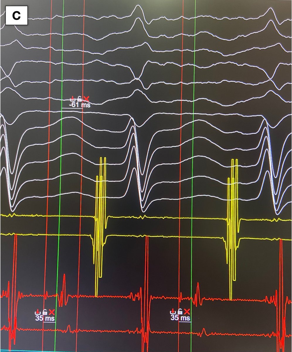 JAldereteM's tweet photo. C) The AP potential precedes the atrial electrogram by 35 ms, which precedes the P wave by 60 ms.
D) Tachycardia terminates <1.5 s after RF delivery.
E) Fluoroscopic view of the successful ablation site.
#Epeeps #Coumel #AVRT https://t.co/Swtk7akXmK