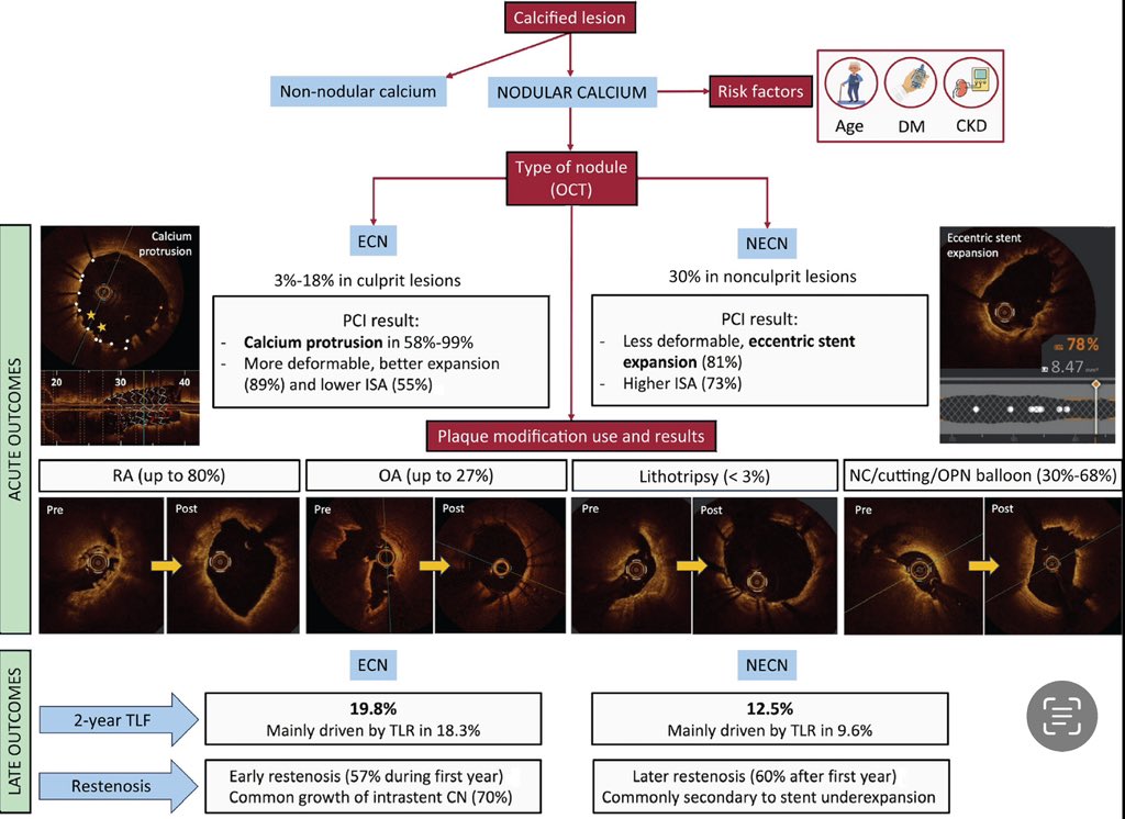 Ignacio J. Amat (@ignamatsant) on Twitter photo Read our updated review on coronary calcified nodules here 👉
sciencedirect.com/science/articl…
<a href="/ClaraFdezCordon/">Clara Fernández Cordón</a> <a href="/esbrilakis/">Emmanouil Brilakis</a> <a href="/PCRonline/">PCRonline 🫀</a> <a href="/secardiologia/">Soc Esp Cardiología</a> <a href="/TCTMD/">TCTMD</a> <a href="/RevEspCardiol/">REC Publications</a>
Graphical abstract 👉 Read our updated review on coronary calcified nodules here 👉
sciencedirect.com/science/articl…
<a href="/ClaraFdezCordon/">Clara Fernández Cordón</a> <a href="/esbrilakis/">Emmanouil Brilakis</a> <a href="/PCRonline/">PCRonline 🫀</a> <a href="/secardiologia/">Soc Esp Cardiología</a> <a href="/TCTMD/">TCTMD</a> <a href="/RevEspCardiol/">REC Publications</a>
Graphical abstract 👉