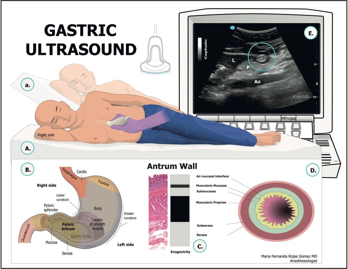 Stephen Haskins (@shaskinsmd) on Twitter photo 🚨 New pub in <a href="/RAPMOnline/">Regional Anesthesia & Pain Medicine</a>!
<a href="/ASRA_Society/">ASRA Pain Medicine</a> expert review - guidance on #GastricUS #POCUS for #aspiration risk in medically complex pts
✅ Labor, urgent C-sec, DM
⚠️ Obesity, emergency, tube feeds, GLP-1RA
❌ GERD, elective C-sec, non-laboring pregnancy
🔓 doi.org/10.1136/rapm-2… 🚨 New pub in <a href="/RAPMOnline/">Regional Anesthesia & Pain Medicine</a>!
<a href="/ASRA_Society/">ASRA Pain Medicine</a> expert review - guidance on #GastricUS #POCUS for #aspiration risk in medically complex pts
✅ Labor, urgent C-sec, DM
⚠️ Obesity, emergency, tube feeds, GLP-1RA
❌ GERD, elective C-sec, non-laboring pregnancy
🔓 doi.org/10.1136/rapm-2…