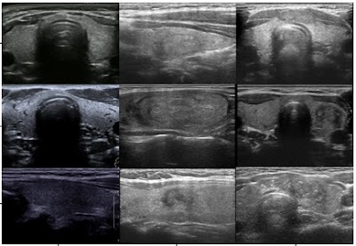 Adaptive dual-task #DeepLearning ThyNet- S model reduced workload in thyroid #cancer screening doi.org/10.1148/ryai.2…  #USRad #ThyroidCancer #MachineLearning