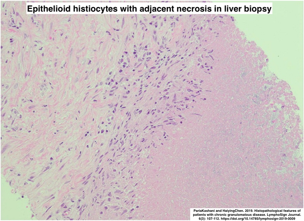 Path4People's tweet image. Not all that is granuloma is sarcoid, infection, drug, etc.

Here's a "BURST" of surprise 🧬 

Children often have recurrent and severe infections, esp S. aureus, S. marcescens, Nocardia, Aspergillus.  

You can find ⬇️ on histo

What is the diagnosis?  

#medstudent #pathx #peds