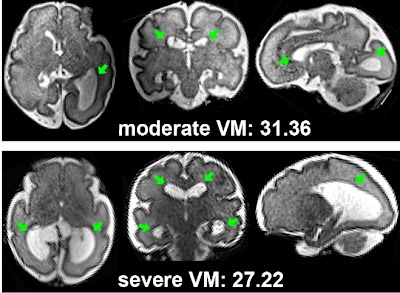 Radiology: Artificial Intelligence (@radiology_ai) on Twitter photo #DeepLearning-based Brain Age Prediction Using #MRI to Identify Fetuses with Cerebral Ventriculomegaly doi.org/10.1148/ryai.2… <a href="/BostonChildrens/">Boston Children's</a> <a href="/boschildrensrad/">Boston Children's Radiology</a> #brain #MachineLearning #AI #DeepLearning-based Brain Age Prediction Using #MRI to Identify Fetuses with Cerebral Ventriculomegaly doi.org/10.1148/ryai.2… <a href="/BostonChildrens/">Boston Children's</a> <a href="/boschildrensrad/">Boston Children's Radiology</a> #brain #MachineLearning #AI