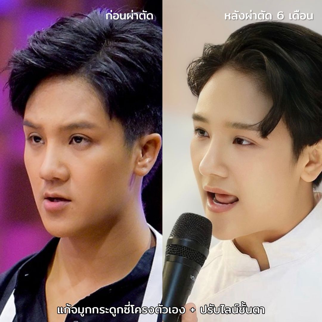 stmstyle_'s tweet photo. 🧑‍🍳#เชฟจ๋า ก่อนและหลังเปลี่ยนแปลงตัวเอง ✨
ดูดีแบบเป็นธรรมชาติสุดๆ คุณ #หมอยังแฮวอน #โรงพยาบาลไอนีค จัดให้ได้ค่าา 🥰

ปรึกษาฟรี! Line Official: https://t.co/z0nCYcwy5u 

#ศัลยกรรม #ทำจมูก #รีวิวศัลยกรรม #เสริมจมูก https://t.co/HuUaOD8MYR