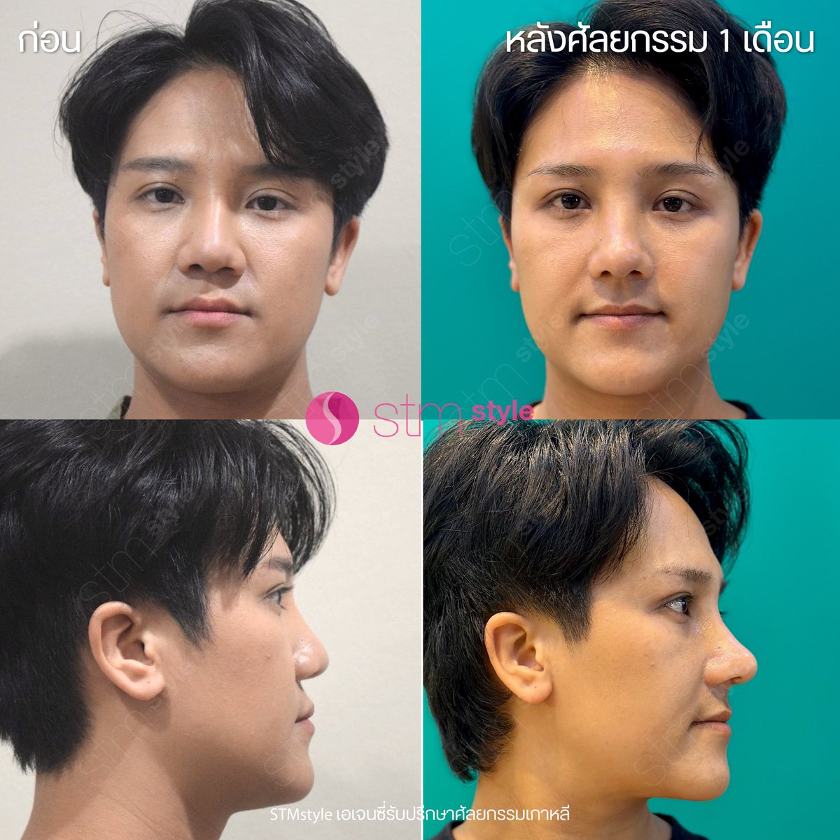 stmstyle_'s tweet photo. 🧑‍🍳#เชฟจ๋า ก่อนและหลังเปลี่ยนแปลงตัวเอง ✨
ดูดีแบบเป็นธรรมชาติสุดๆ คุณ #หมอยังแฮวอน #โรงพยาบาลไอนีค จัดให้ได้ค่าา 🥰

ปรึกษาฟรี! Line Official: https://t.co/z0nCYcwy5u 

#ศัลยกรรม #ทำจมูก #รีวิวศัลยกรรม #เสริมจมูก https://t.co/HuUaOD8MYR