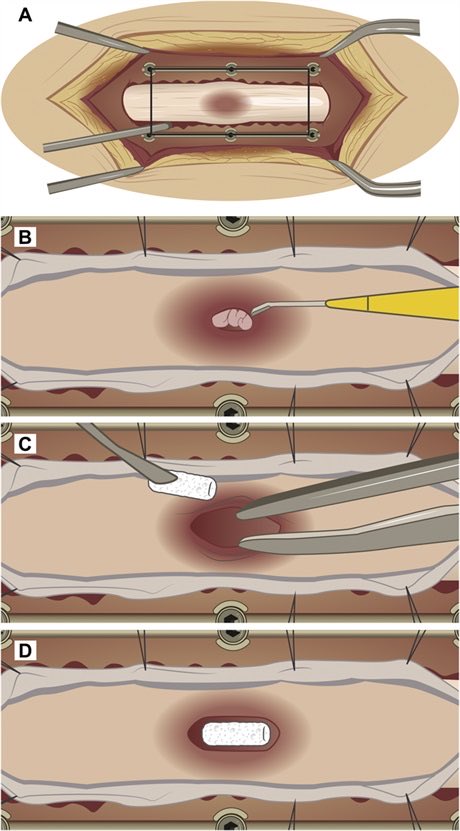 Kurt Yaeger (@dr_yaeger) on Twitter photo Implantation of bioresorbable polymer scaffold in acute #SCI did not show improvement compared to control in RCT
…but this is the type of innovation that changes lives in the future! More studies like this are needed
<a href="/NeurosurgeryCNS/">Neurosurgery Publications</a>
journals.lww.com/neurosurgery/f… Implantation of bioresorbable polymer scaffold in acute #SCI did not show improvement compared to control in RCT
…but this is the type of innovation that changes lives in the future! More studies like this are needed
<a href="/NeurosurgeryCNS/">Neurosurgery Publications</a>
journals.lww.com/neurosurgery/f…