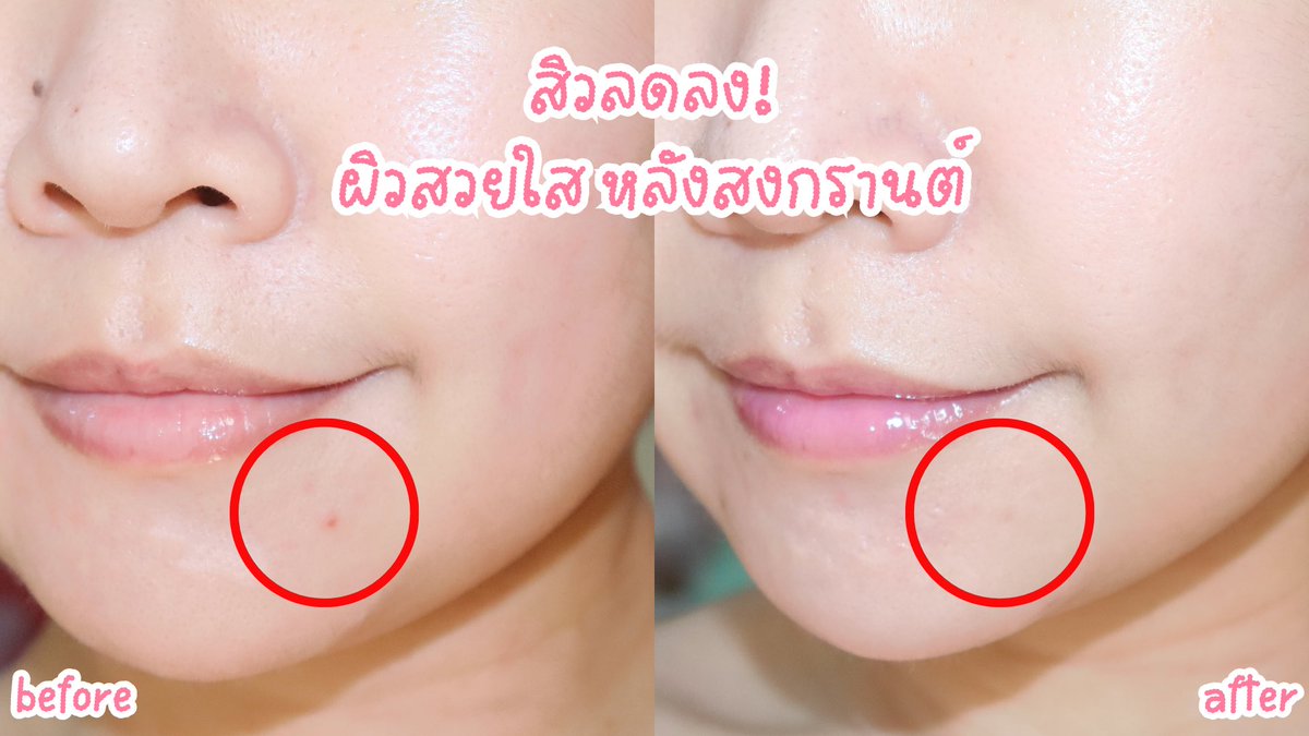 เตรียมผิวใสไร้สิวหลังสงกรานต์ แถมอร่อยด้วย🤣 นี่ทานเจลลี่ลดสิวตัวนี้ตลอดด เขามี ZinC ช่วยลดการเกิดสิว น้ำตาล 0% กลิ่นพีช หอมอร่อยสดชื่นมากๆ แค่ 20 บาทก็มีผิวใสๆได้แล้ว ไปลองงง พิกัด 7-11

 #JellyMe #JellyMeCuti #ความคิวทิบิลด์ง่ายได้ทุกวัน #JellyMeZinc #ลดสิว #HowtoPerfect https://t.co/4advUFkXKu