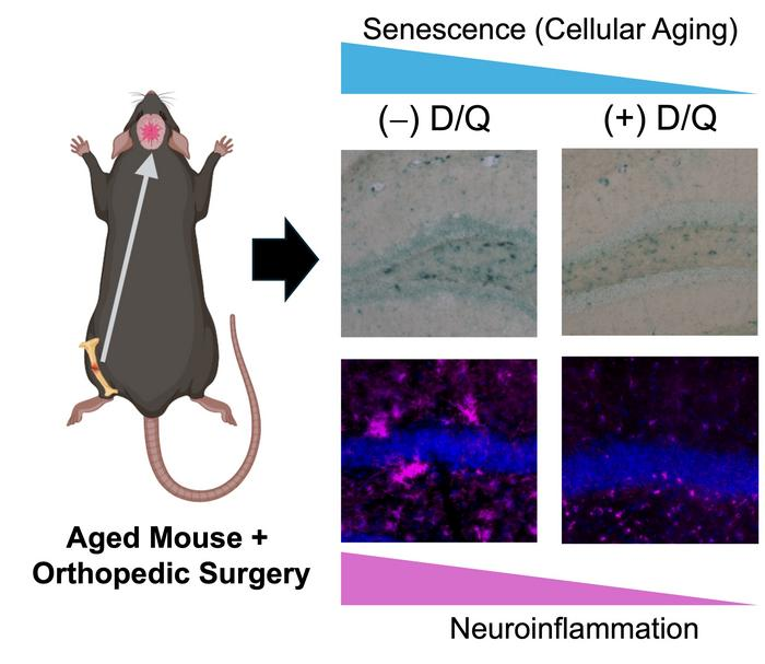 TimePie (focus on anti-aging science) (@timepiechina) on Twitter photo Reducing cellular #senescence can prevent #neuroinflammation, accoring to a new study by <a href="/shynivarghese/">shyni varghese</a> & the team.
Treated mice with Dasatinib and Quercetin showed a significant reduction in surgery-induced neuroinflammation compared to untreated mice.
doi.org/10.1093/pnasne… Reducing cellular #senescence can prevent #neuroinflammation, accoring to a new study by <a href="/shynivarghese/">shyni varghese</a> & the team.
Treated mice with Dasatinib and Quercetin showed a significant reduction in surgery-induced neuroinflammation compared to untreated mice.
doi.org/10.1093/pnasne…