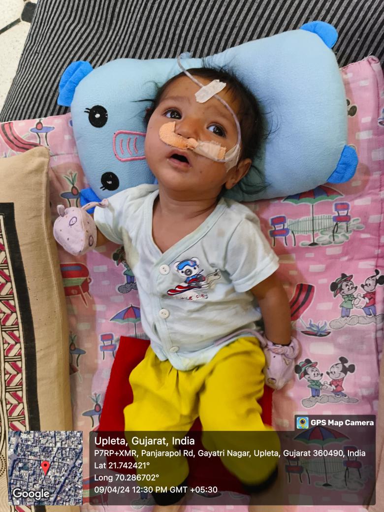 SbccHealth's tweet image. રાષ્ટ્રીય બાળ સ્વાસ્થ્ય કાર્યક્રમ અંતર્ગત ઉપલેટા તાલુકાની કેશવીને જન્મજાત ક્લેફ્ટ પેલેટ(તૂટેલ ટાળવું )ની ખામી ધ્રુવ હોસ્પિટલ રાજકોટમાં વિના મૂલ્યે સર્જરી કરી ખામી દૂર કરવામાં આવી @RajkotCdho00031 @DDORAJKOT1 @CollectorRjt @NHMGujarat @GujHFWDept