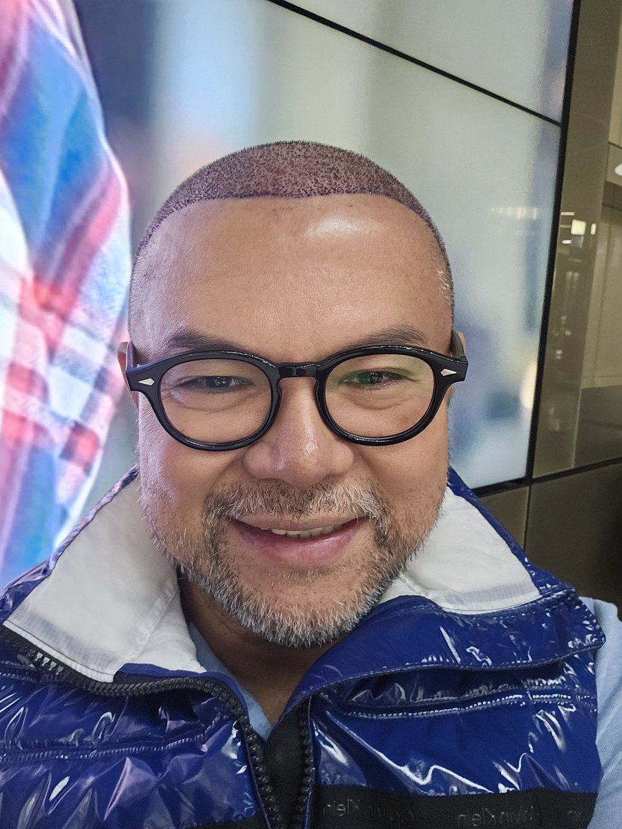 butch_manong's tweet image. My hair transformation after 15 months!

#hairtransplant
#hairtransformation
#İstanbul