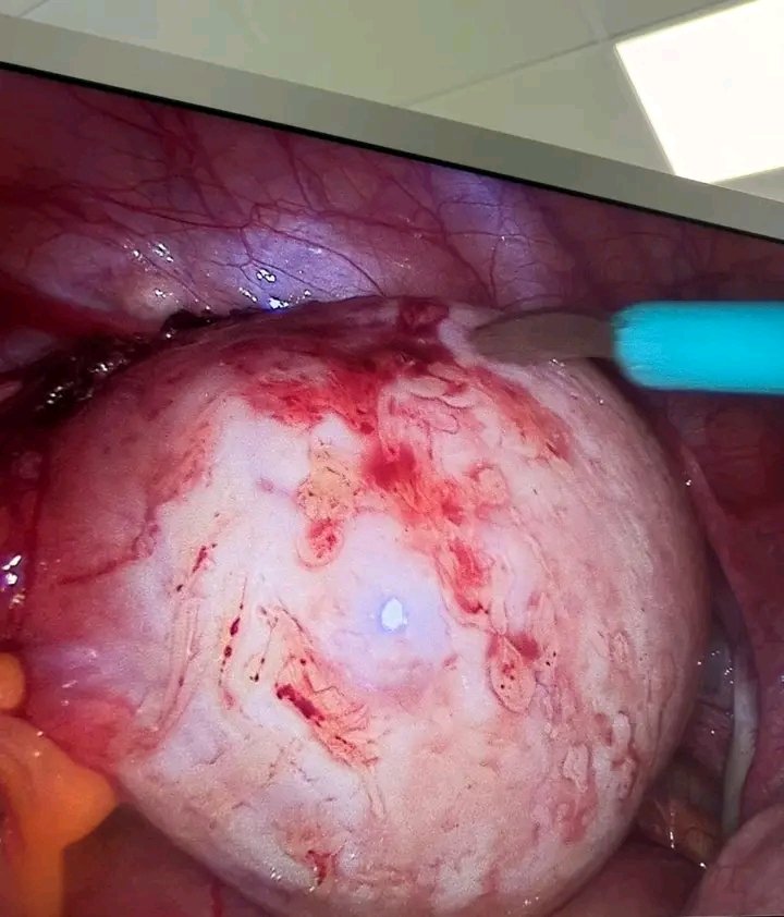 Miraisy71's tweet photo. Médico cubano Dr Mario Enrique Berea Turiño, Especialista en Obstetricia y Ginecología que trabaja en el hospital de Cetraro, provincia de Cosenza Italia,junto a colega italiano realizando cirugía  mínimo acceso en una joven con endometrioma de ovario izquierdo.
#cubaitalia https://t.co/WMURxUafmx
