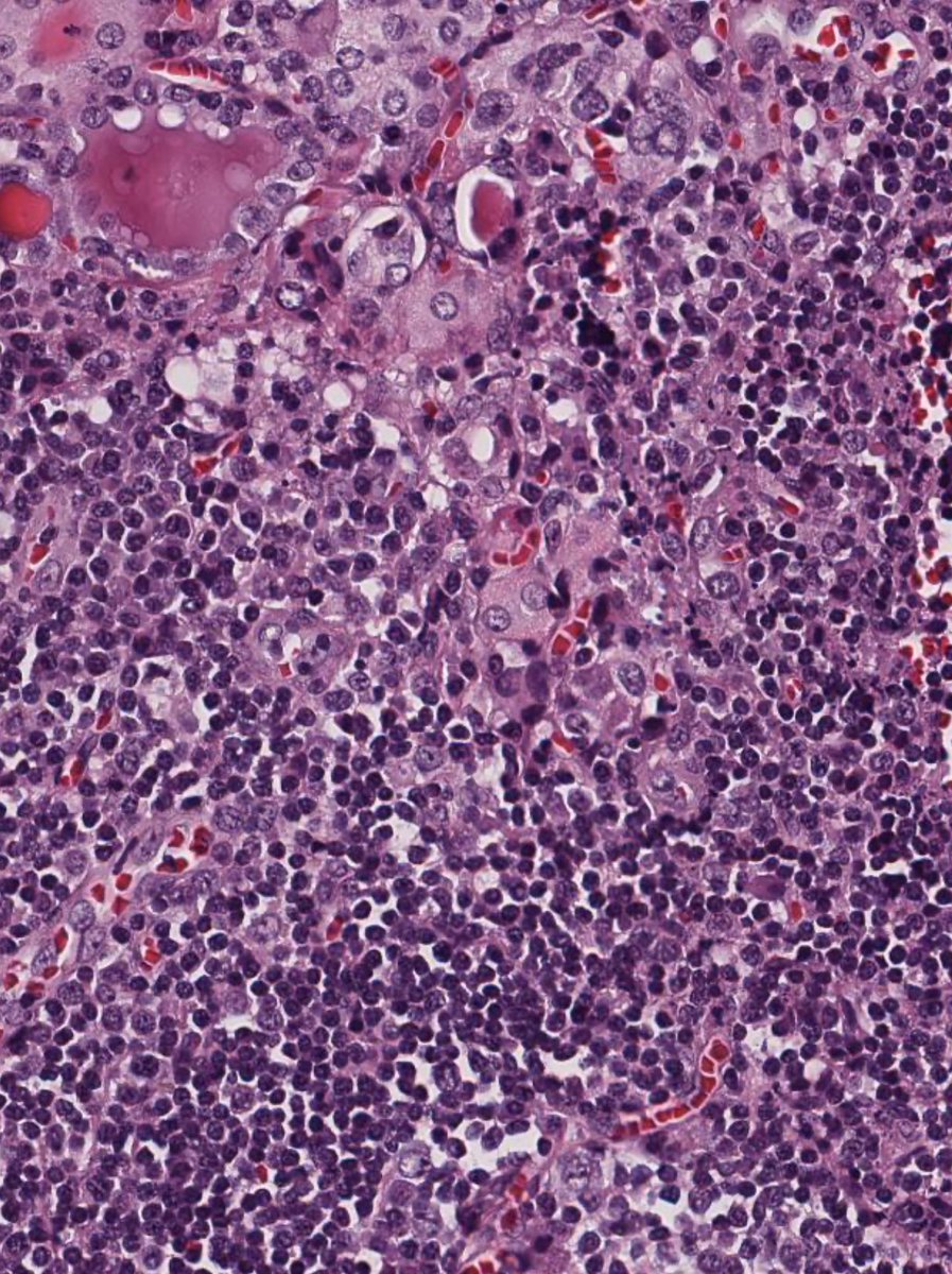 Pathology_mcqs's tweet photo. Think it’s a lymph node? Think again. ☢️Swipe ➡️ to find out.
These follicles are feeling a little out of place.
No story. Or History
What is your diagnosis? Comment your thoughts.
#Pathology
#Histopathology
#MicroscopyMonday
#PathologyCase
#PathologyEducation
#FRCPath https://t.co/zyvJUyj2FE