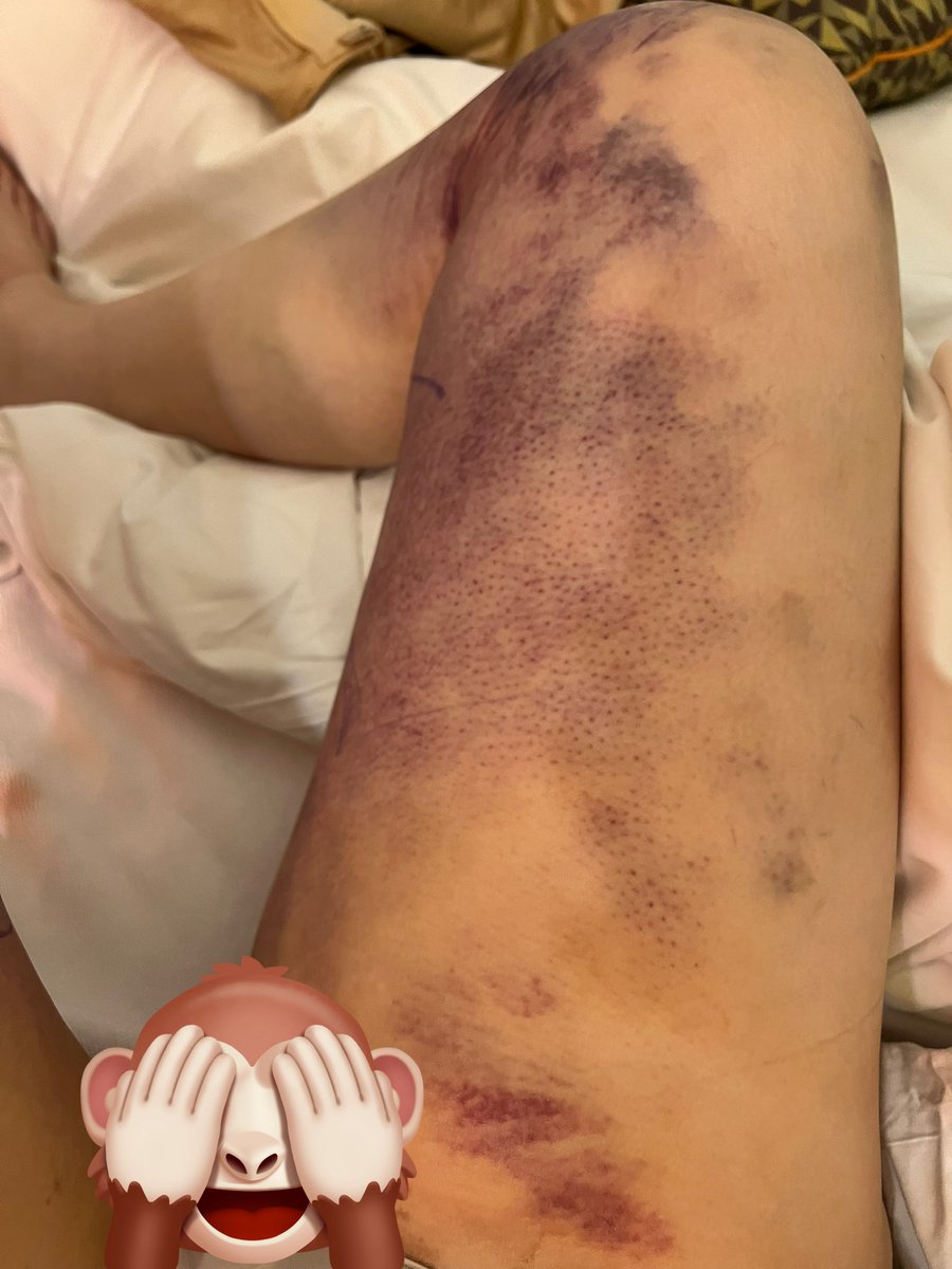 太ももお尻dt3日目
☑️内側は青あざが酷い
☑️昨日より太い
☑️ふくらはぎの乾燥がすごい
☑️痛み止めを飲むペースがましになった
☑️圧迫着を着てる方が動きやすい
明日日本に帰国🇯🇵
お犬様が膝に乗ってきたら終わる😂笑笑