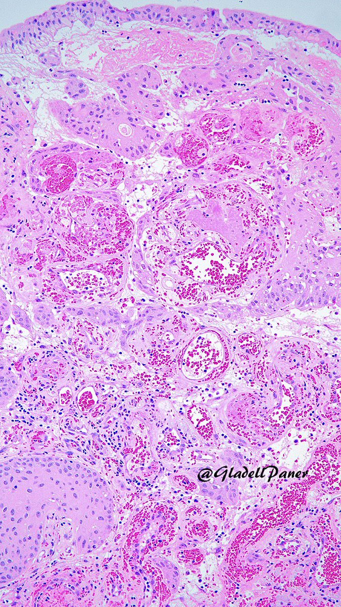 GladellPaner's tweet photo. Benign or malignant, that’s the question.
Diagnosis on this #urinarybladder biopsy? #GUPath #OnePicDx
Answer in comment. 👇👇👇 https://t.co/Wb9edULMQr