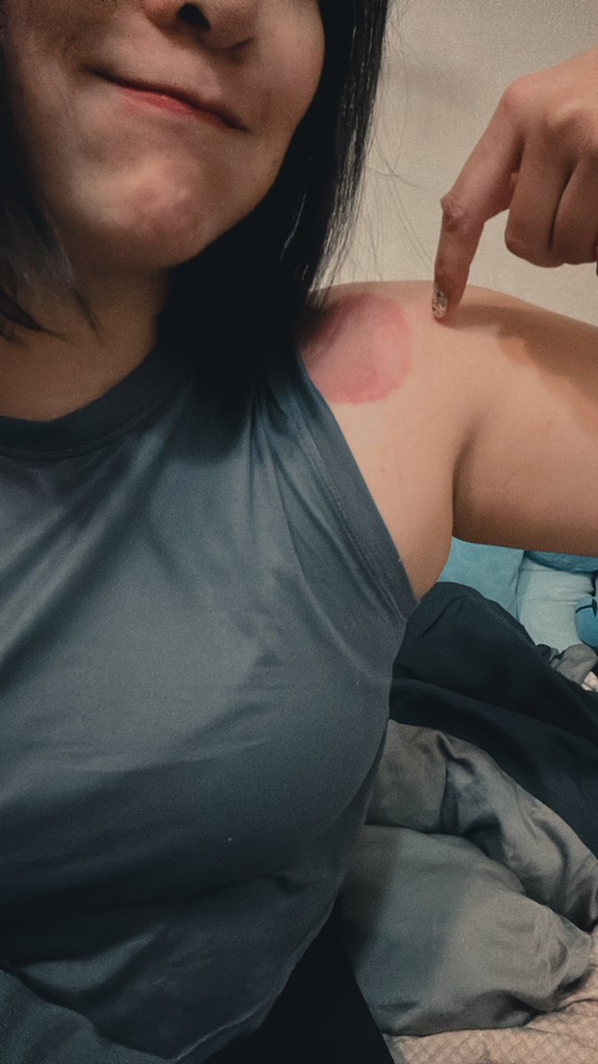 獲得多枚拔罐圈圈🤣
#沒有露奶照 https://t.co/IjYC67JtcX
