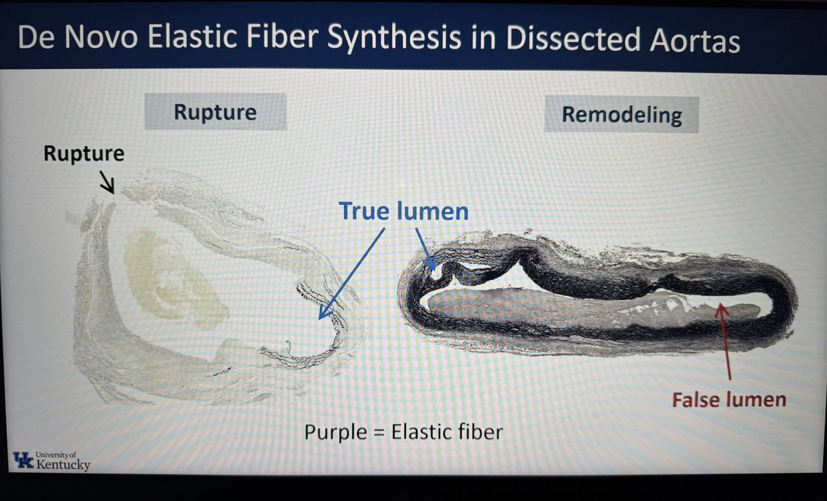 SamTyagiMD's tweet image. Excellent talk @VascularSVS #VRIC by @SoheiIto of @hisashi_sawada Lab on the novel finding of de novo elastic fibers in chronic aortic dissection! They told us in school, no new elastin! Wow 🤯! @GillKentucky @UK_HealthCare @UKvascular See poster at #VascularDiscovery25