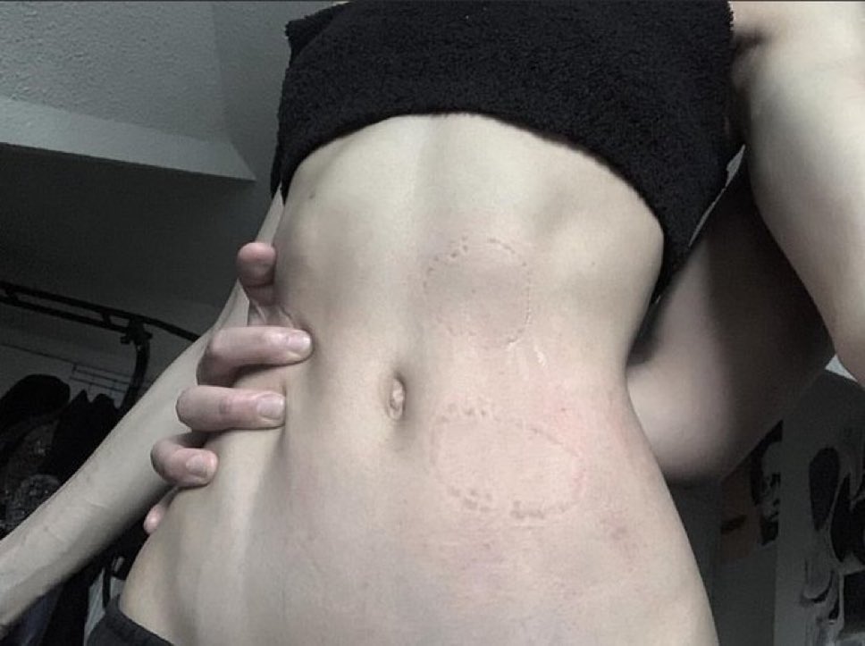 คันเขี้ยว