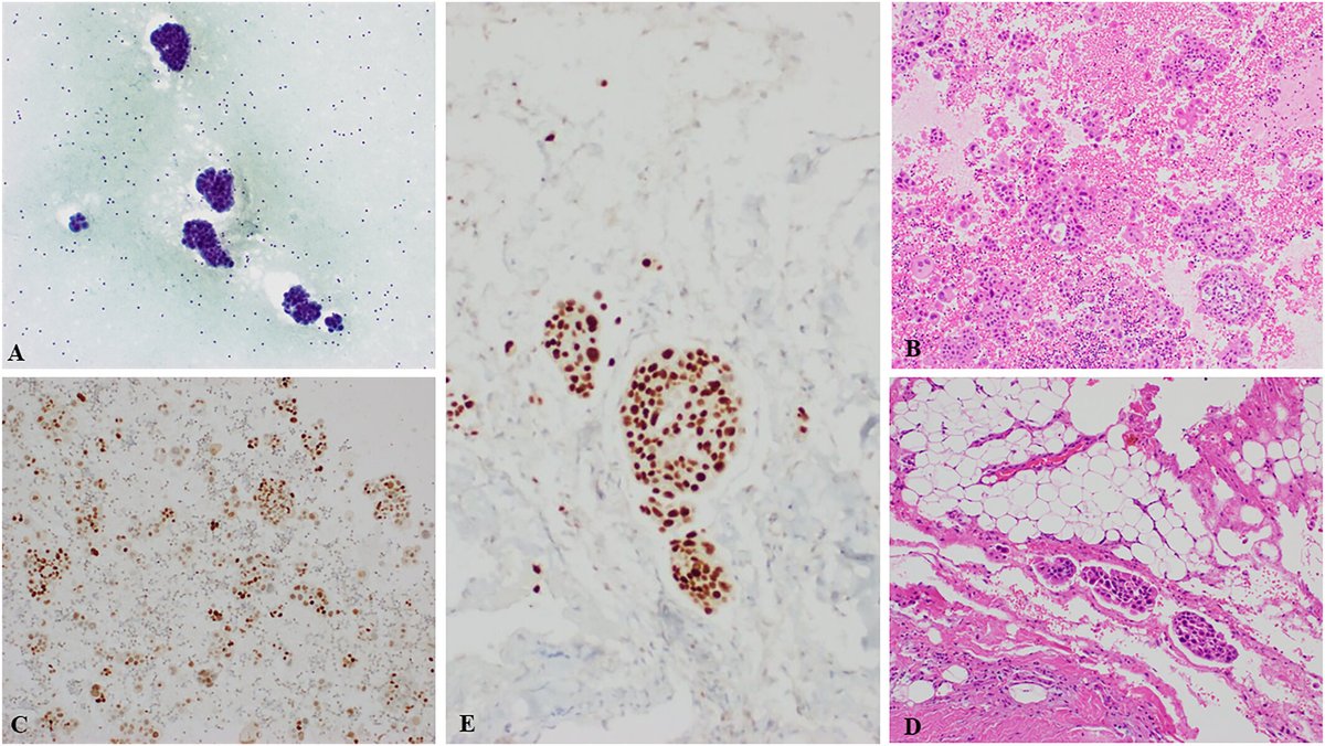 CancerCytopath's tweet photo. 💥 This study examines pericardial fluid evaluation, comparing cytology vs. surgical specimens for malignancy detection. The findings highlight diagnostic yield of cytology. 

Read more: https://t.co/y7MdrZrPmq 

@drElieTannous #CytoPath https://t.co/dRU5QQQ4Ar