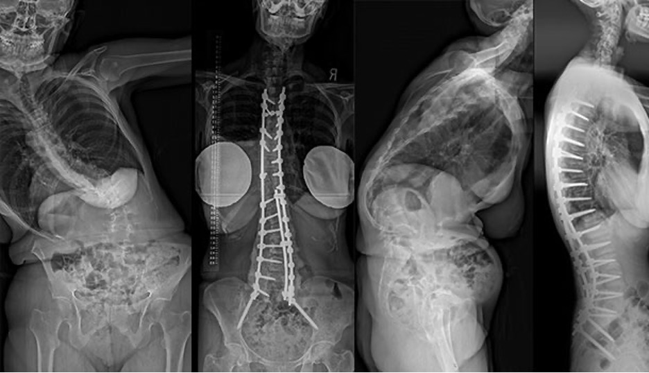 HSS Education Institute (@hssprofed) on Twitter photo 📬You're invited to <a href="/HSpecialSurgery/">Hospital for Special Surgery (HSS)</a> for a 1-day course focused on the evolving field of spinal alignment, with insights into the latest concepts and practices.
📅 June 6 | 📍HSS & Virtual
Register for the 2025 David B. Levine, MD, HSS Spine Symposium: 2025hssspinesymposium.vfairs.com/en/?utm_source… 📬You're invited to <a href="/HSpecialSurgery/">Hospital for Special Surgery (HSS)</a> for a 1-day course focused on the evolving field of spinal alignment, with insights into the latest concepts and practices.
📅 June 6 | 📍HSS & Virtual
Register for the 2025 David B. Levine, MD, HSS Spine Symposium: 2025hssspinesymposium.vfairs.com/en/?utm_source…