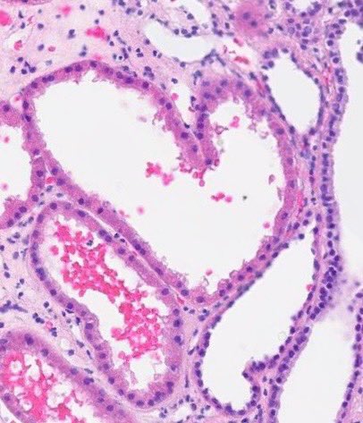 DrAhmedKalebi's tweet image. Some kidney love from this renal tubule ❤️ #RenalPath #Renal #NephroPath