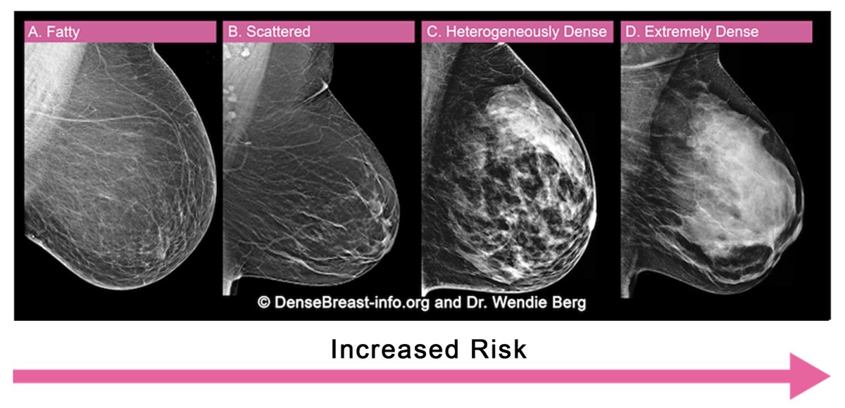 STUDY: Women’s health care providers knowledge gaps about dense breasts + risk. In our study only 29% knew risk increases with increasing breast density. Education continues to be needed on all fronts: journals.lww.com/menopausejourn…
<a href="/RobinSeitzman/">Robin Seitzman, PhD, MPH</a> <a href="/DrWendieBerg/">DrWendieBerg</a> <a href="/JoAnnPushkin/">JoAnn Pushkin</a>