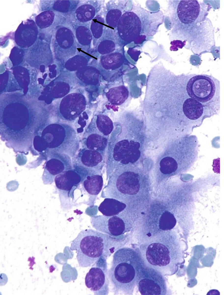 Thyroid follicular cells with multiple intranuclear pseudoinclusions.
🧐🧐
What would you call it?

A) Benign
B) Atypical
C) Malignant

#CytoPath #PathTwitter #Pathology