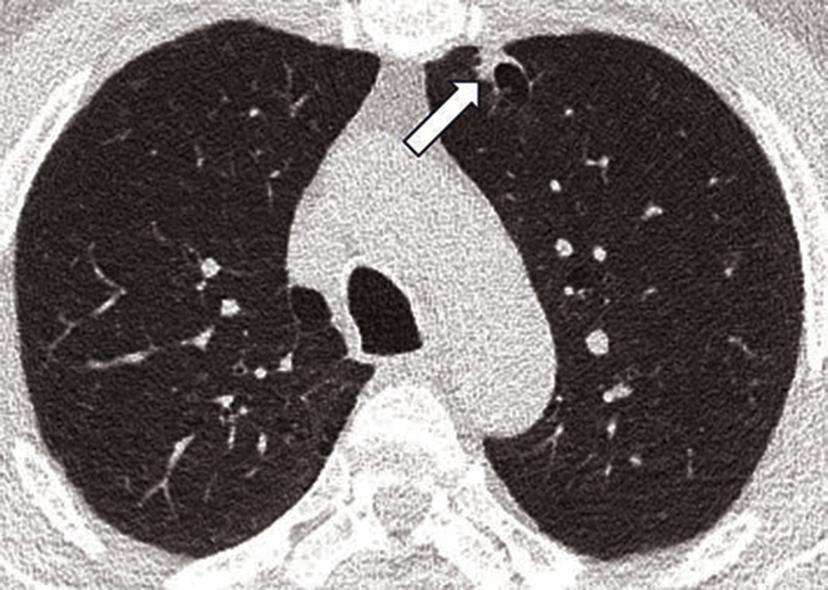 This study evaluated different AI utilization scenarios for LDCT lung cancer screening and found that using AI as a prescreener reduced interpretation time and had the highest net benefit compared to using AI as an assistant or backup.

ajronline.org/doi/10.2214/AJ…