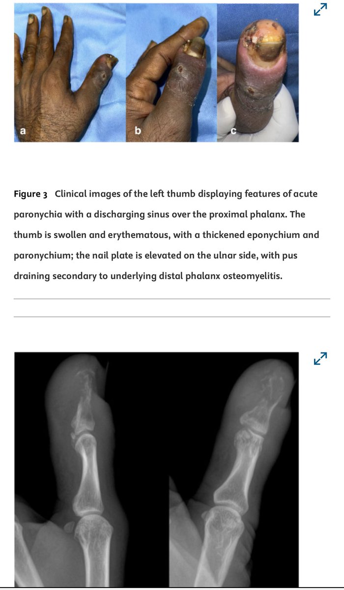 Terrence Jose Jerome, FRCS (@terrencejose) on Twitter photo Our new surgical classification for distal phalanx osteomyelitis is out in JCOT.Scopus 4.3, IF 1.7. Surgical Management for Distal Phalanx Osteomyelitis: Narrative Review doi.org/10.1016/j.jcot… <a href="/JHandSurg/">J Hand Surg Am- ASSH</a> <a href="/jbjs/">J Bone & Joint Surg</a> <a href="/JHSEur/">The Journal of Hand Surgery (European Volume)</a> <a href="/prsjournal/">Plastic and Reconstructive Surgery</a> <a href="/PRSGlobalOpen/">PRS Global Open</a> <a href="/BoneJointJ/">The Bone & Joint Journal</a> <a href="/FESSHEurope/">FESSH</a> <a href="/AAOS1/">AAOS</a> Our new surgical classification for distal phalanx osteomyelitis is out in JCOT.Scopus 4.3, IF 1.7. Surgical Management for Distal Phalanx Osteomyelitis: Narrative Review doi.org/10.1016/j.jcot… <a href="/JHandSurg/">J Hand Surg Am- ASSH</a> <a href="/jbjs/">J Bone & Joint Surg</a> <a href="/JHSEur/">The Journal of Hand Surgery (European Volume)</a> <a href="/prsjournal/">Plastic and Reconstructive Surgery</a> <a href="/PRSGlobalOpen/">PRS Global Open</a> <a href="/BoneJointJ/">The Bone & Joint Journal</a> <a href="/FESSHEurope/">FESSH</a> <a href="/AAOS1/">AAOS</a>