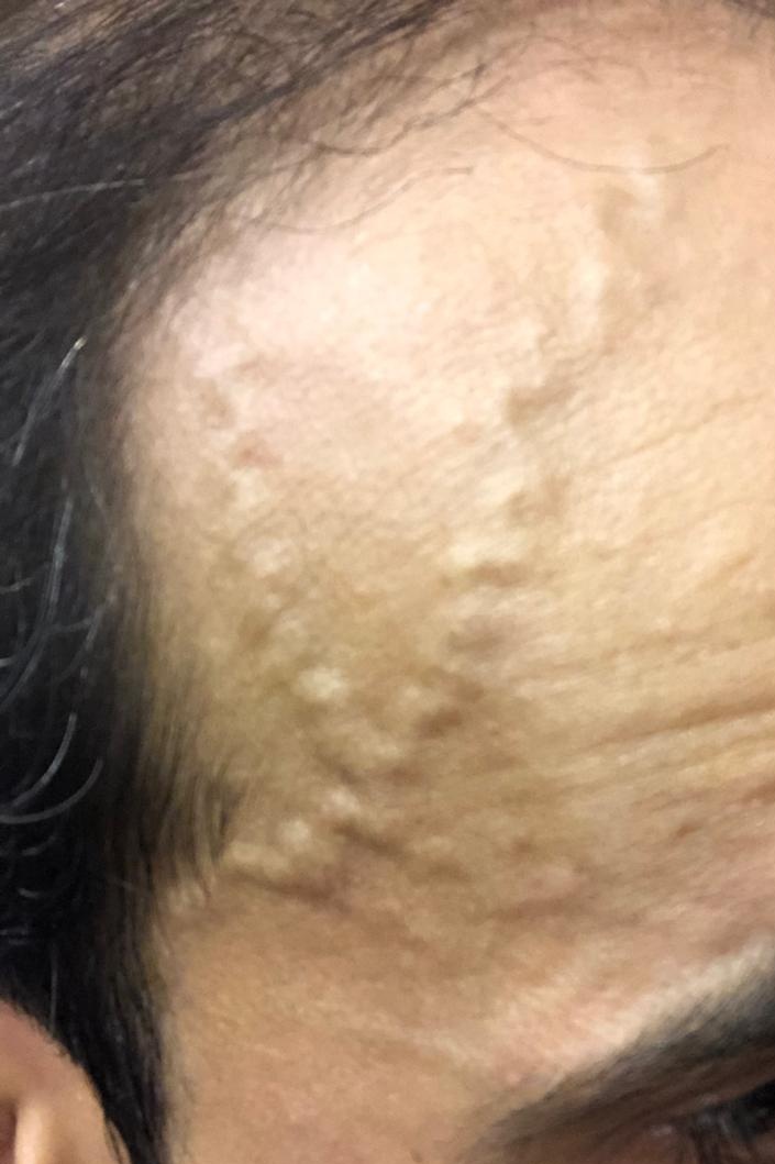 What is the cause of headache?