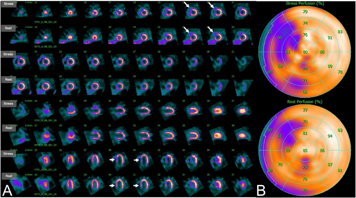 Journal of Nuclear Cardiology (@jncjournal) on Twitter photo A case of a dual LAD system presenting as atypical anteroseptal ischemia on MPI. <a href="/razaabbas14/">Raza Abbas</a> <a href="/Harpreet1006/">HARPREET SINGH</a>
Read now👉bit.ly/44CwF6A
#cvnuc A case of a dual LAD system presenting as atypical anteroseptal ischemia on MPI. <a href="/razaabbas14/">Raza Abbas</a> <a href="/Harpreet1006/">HARPREET SINGH</a>
Read now👉bit.ly/44CwF6A
#cvnuc