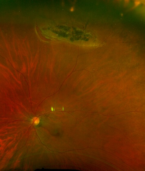 RetinaSociety's tweet photo. Retinal break adjacent to a patch of lattice degeneration. https://t.co/wb4g0DsC5l