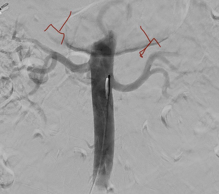 For those using Recors RDN device, would you do a sonification past the (early) first branch/bifurcation.
