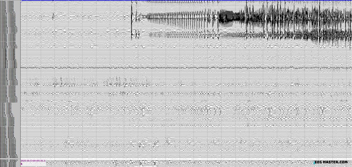 34 yo with seizures described as hot flashes -&gt; staring, oral automatisms &amp; right hand tonic-clonic movements. Using the sEEG provided (electrode labels per SENSA) localize his onset? Click on the link to see options, submit answer &amp; view explanation.  eegmaster.com/eegmaster/quiz…
