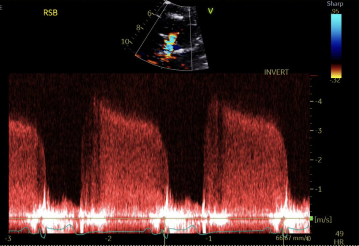 Priscilla Wessly (@pwesslymd) on Twitter photo <a href="/NadeenFaza/">Nadeen N. Faza, M.D.</a> <a href="/ASE360/">American Society of Echocardiography</a> <a href="/JournalASEcho/">JASE</a> <a href="/pattypellikka/">Dr.Patricia Pellikka</a> <a href="/Vidhu_anand/">Vidhu</a> <a href="/iamritu/">Ritu Thamman MD</a> <a href="/EGarciaSayan/">Enrique Garcia-Sayan, MD, FACC, FASE</a> <a href="/renujain19/">Renu</a> <a href="/SIwa23288585/">IWASHIMA Satoru岩島覚.MD, PhD.ヤー</a> <a href="/rajdoc2005/">Raj Janardhanan, MD, MRCP, FACC, FASE</a> <a href="/purviparwani/">Dr. Purvi Parwani</a> <a href="/MaanMalahfji/">Maan Malahfji</a> <a href="/LucySafi/">Lucy</a> <a href="/DrDeepa1020/">Deepa</a> <a href="/DavidWienerMD/">David H. Wiener, MD</a> Same patient CW Doppler from Apical(left) and RSB window(right). 📍Parasternal/RSB = better alignment for eccentric jets #EchoFirst #ASEchoJC <a href="/ASE360/">American Society of Echocardiography</a> <a href="/NadeenFaza/">Nadeen N. Faza, M.D.</a> <a href="/pattypellikka/">Dr.Patricia Pellikka</a> <a href="/iamritu/">Ritu Thamman MD</a> <a href="/NadeenFaza/">Nadeen N. Faza, M.D.</a> <a href="/ASE360/">American Society of Echocardiography</a> <a href="/JournalASEcho/">JASE</a> <a href="/pattypellikka/">Dr.Patricia Pellikka</a> <a href="/Vidhu_anand/">Vidhu</a> <a href="/iamritu/">Ritu Thamman MD</a> <a href="/EGarciaSayan/">Enrique Garcia-Sayan, MD, FACC, FASE</a> <a href="/renujain19/">Renu</a> <a href="/SIwa23288585/">IWASHIMA Satoru岩島覚.MD, PhD.ヤー</a> <a href="/rajdoc2005/">Raj Janardhanan, MD, MRCP, FACC, FASE</a> <a href="/purviparwani/">Dr. Purvi Parwani</a> <a href="/MaanMalahfji/">Maan Malahfji</a> <a href="/LucySafi/">Lucy</a> <a href="/DrDeepa1020/">Deepa</a> <a href="/DavidWienerMD/">David H. Wiener, MD</a> Same patient CW Doppler from Apical(left) and RSB window(right). 📍Parasternal/RSB = better alignment for eccentric jets #EchoFirst #ASEchoJC <a href="/ASE360/">American Society of Echocardiography</a> <a href="/NadeenFaza/">Nadeen N. Faza, M.D.</a> <a href="/pattypellikka/">Dr.Patricia Pellikka</a> <a href="/iamritu/">Ritu Thamman MD</a>