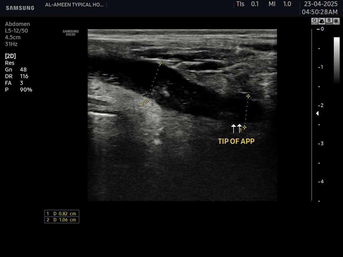 EchoTech_4's tweet photo. a case of Acute Obstructive Appendicitis in a 22 years male patient presents with Periumbilical pain and nausea since 12 hours.
In such cases we recommend urgent surgical intervention to avoid further complications as Perforation , abscess , peritoniti ,Etc…
#Echo_Tech https://t.co/HAb9mLeEMj