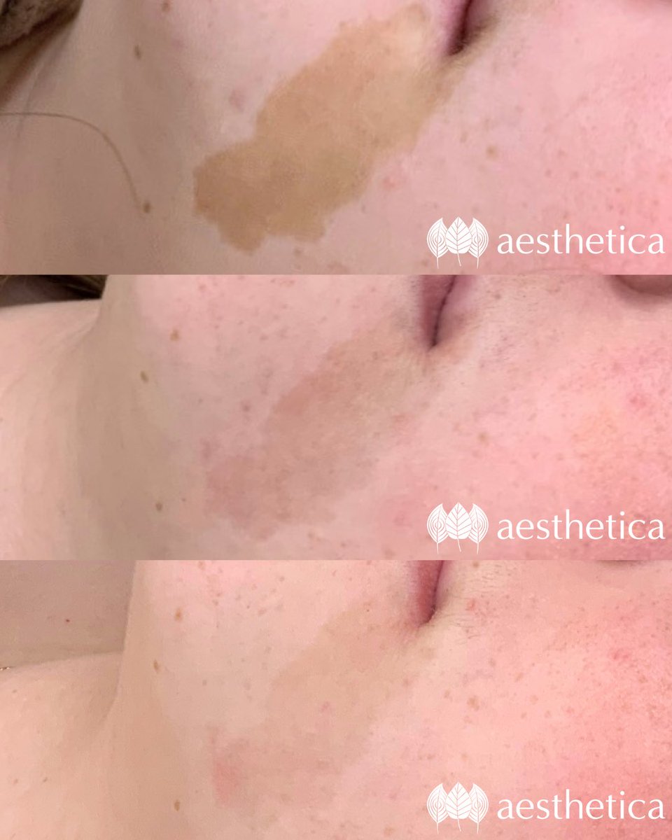 Laser treatments can be life-changing 🙌 Kylee treated this patient’s cafe au lait birthmark and acheived these awesome results after 3 PicoWay treatments! 

Café au lait spots are flat, light brown patches on the skin that some people are born with. Call (801) 785-8884.