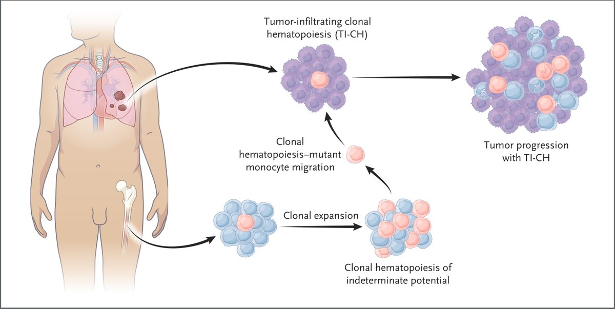 New evidence today <a href="/NEJM/">NEJM</a> that age-related clonal hematopoiesis (CHIP) has a driver role in evolution of solid cancers
nejm.org/doi/full/10.10…
nejm.org/doi/full/10.10…