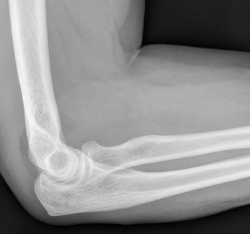 Shingo_Omata's tweet photo. <What’s your diagnosis?>
Pt: 47M
CC: Post fall of bicycle.
#Rdiag #RadEd #MedEd #MSKrad #ERrad #FOAMrad #FOAMed https://t.co/RcRuY5Pe0O