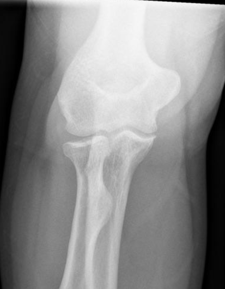 Shingo_Omata's tweet photo. <What’s your diagnosis?>
Pt: 47M
CC: Post fall of bicycle.
#Rdiag #RadEd #MedEd #MSKrad #ERrad #FOAMrad #FOAMed https://t.co/RcRuY5Pe0O