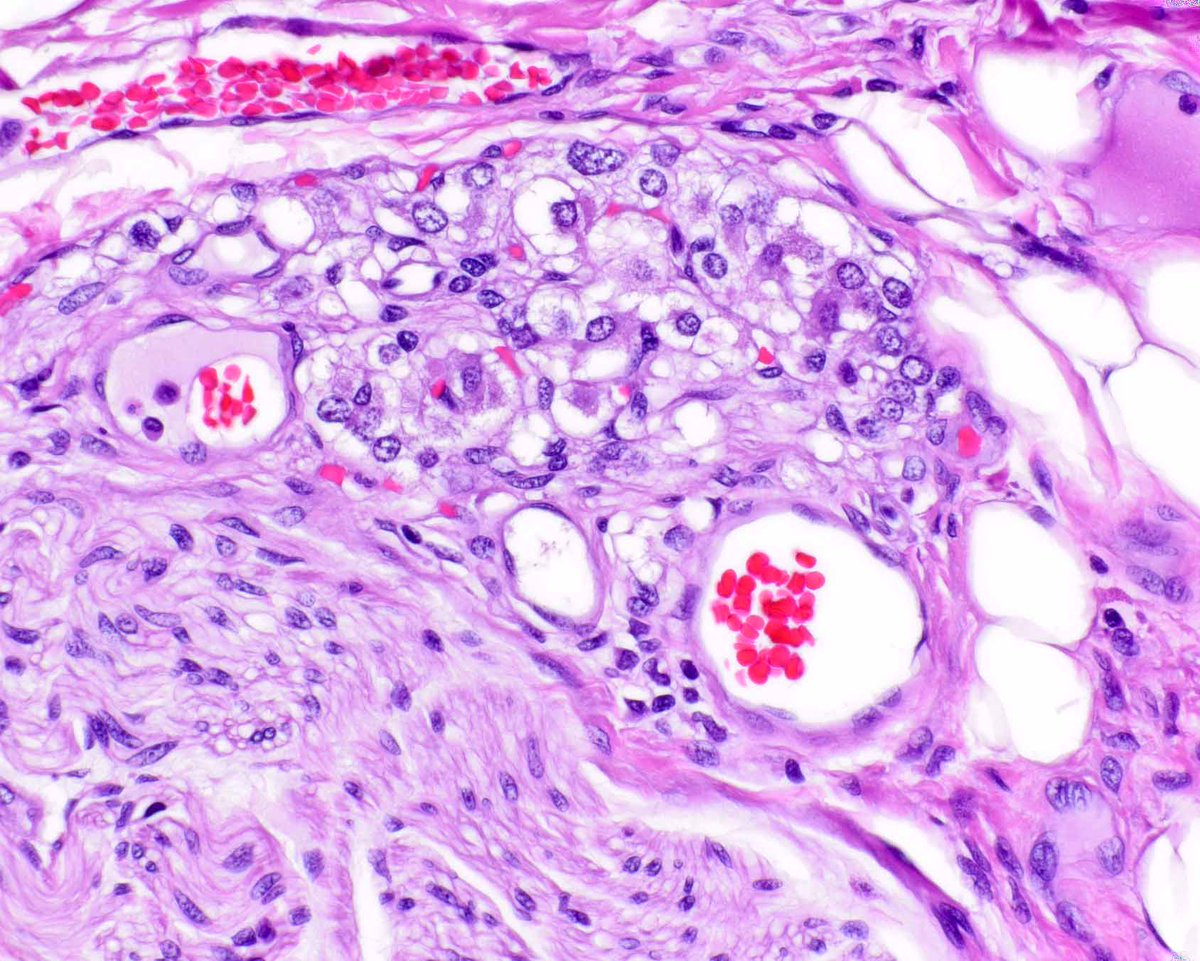 Elizabeth Montgomery, MD (@lizmontgomerymd) on Twitter photo Incidental finding from a resection. There is a paraganglion atop a nerve. This is not a paraganglioma nor a neuroendocrine (carcinoid) tumor; were one to stain it, keratins would be negative (and neuroendocrine markers positive). #UMiamiPath <a href="/ModernPathology/">Modern Pathology</a> <a href="/science_press/">Innovative Science Press</a> Incidental finding from a resection. There is a paraganglion atop a nerve. This is not a paraganglioma nor a neuroendocrine (carcinoid) tumor; were one to stain it, keratins would be negative (and neuroendocrine markers positive). #UMiamiPath <a href="/ModernPathology/">Modern Pathology</a> <a href="/science_press/">Innovative Science Press</a>