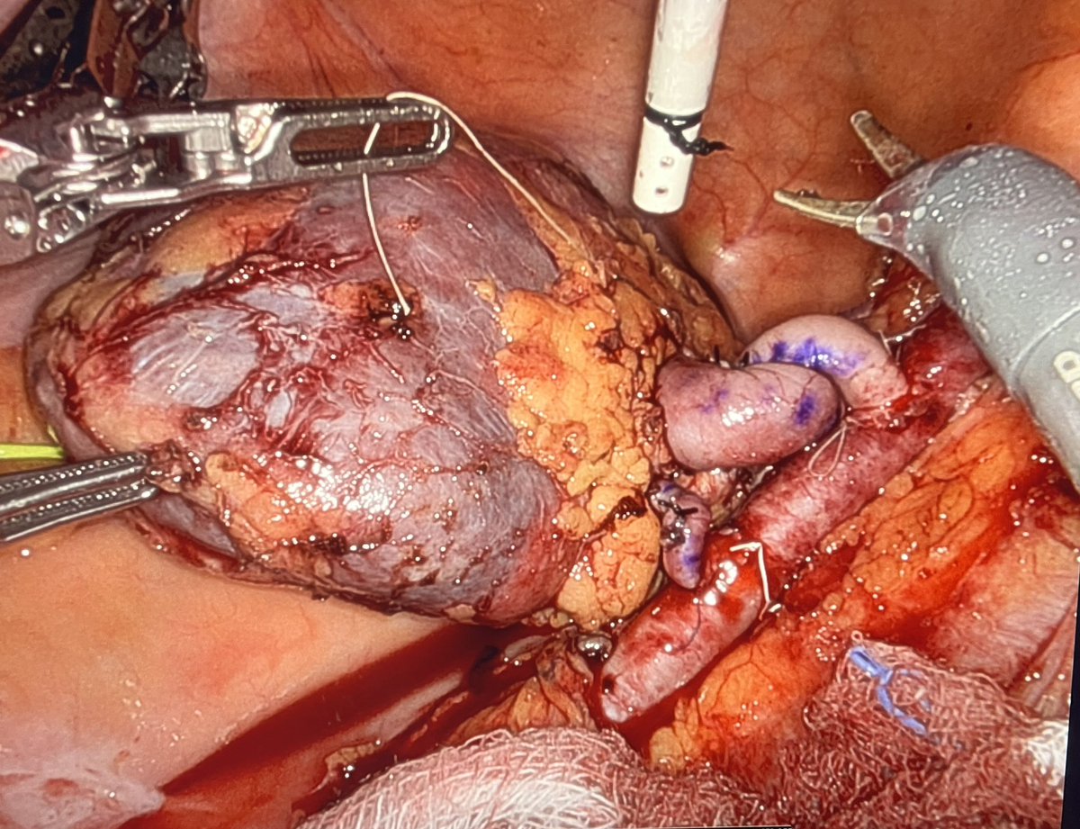 Sami Shoucair, MD MPH MS (@samishoucair) on Twitter photo Two arteries … two days in a row… Taking on challenges and performing with excellence <a href="/ClevelandClinic/">Cleveland Clinic</a>.
Marking our 35th robotic 🤖 kidney 🫘 transplant for the year! Honored to learn from <a href="/moeltemamy/">Mohamed Eltemamy</a> <a href="/CleClinicUro/">Cleveland Clinic Urology</a>!
<a href="/me4_so/">SoMe4Surgery</a> #MedTwitter <a href="/IntuitiveSurg/">Intuitive</a> #surgery Two arteries … two days in a row… Taking on challenges and performing with excellence <a href="/ClevelandClinic/">Cleveland Clinic</a>.
Marking our 35th robotic 🤖 kidney 🫘 transplant for the year! Honored to learn from <a href="/moeltemamy/">Mohamed Eltemamy</a> <a href="/CleClinicUro/">Cleveland Clinic Urology</a>!
<a href="/me4_so/">SoMe4Surgery</a> #MedTwitter <a href="/IntuitiveSurg/">Intuitive</a> #surgery