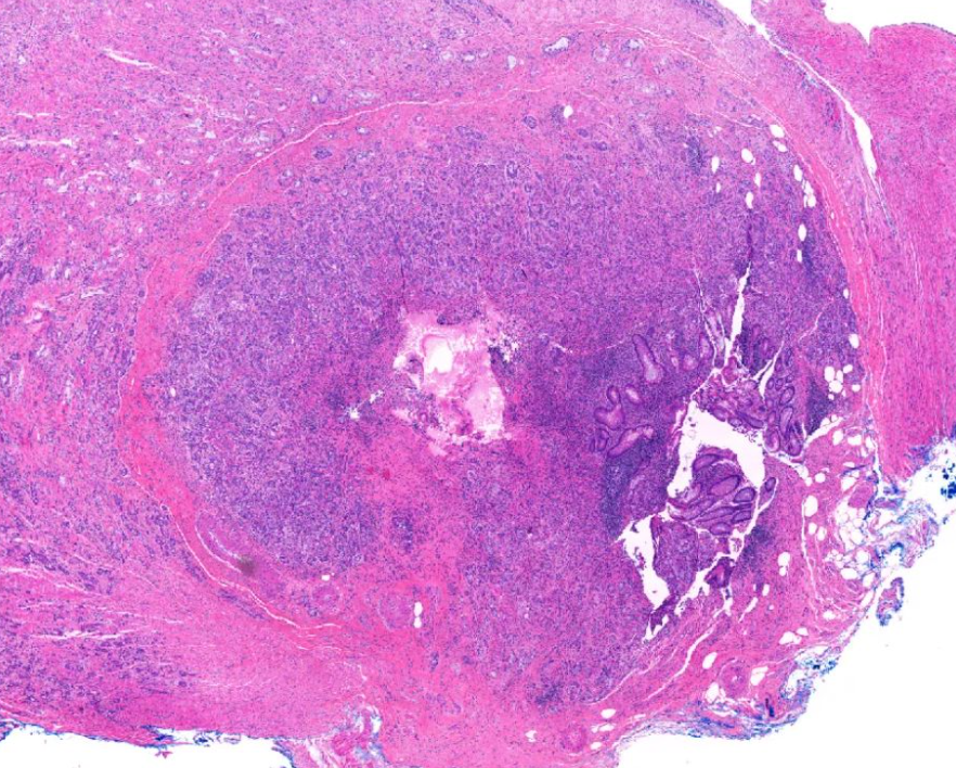 TheLabDoc's tweet photo. 🔴Goblet cell adenocarcinoma of distal appendix
Note expansion of appendix wall, goblet cell morphology (cell groups dissect through muscularis propria)
Grade according to tubular pattern (G1 >75%; G2 50-75%; G3 <50%)
🧬WNT pathway, ARID1/2
#KnowToPass #PathBoards #PathTwitter https://t.co/triSIGMUFL