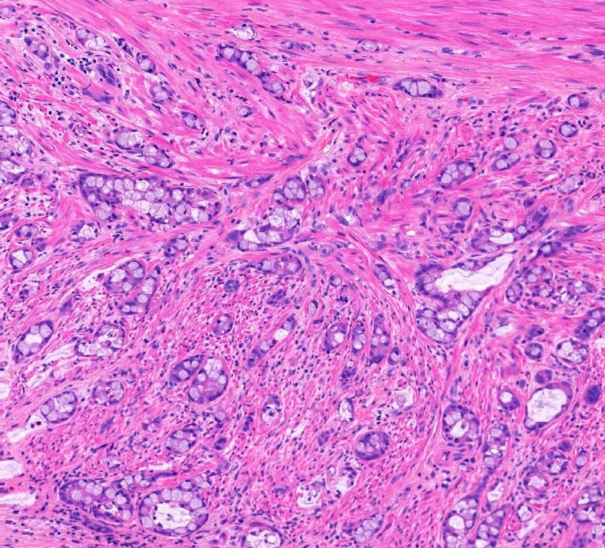 TheLabDoc's tweet photo. 🔴Goblet cell adenocarcinoma of distal appendix
Note expansion of appendix wall, goblet cell morphology (cell groups dissect through muscularis propria)
Grade according to tubular pattern (G1 >75%; G2 50-75%; G3 <50%)
🧬WNT pathway, ARID1/2
#KnowToPass #PathBoards #PathTwitter https://t.co/triSIGMUFL