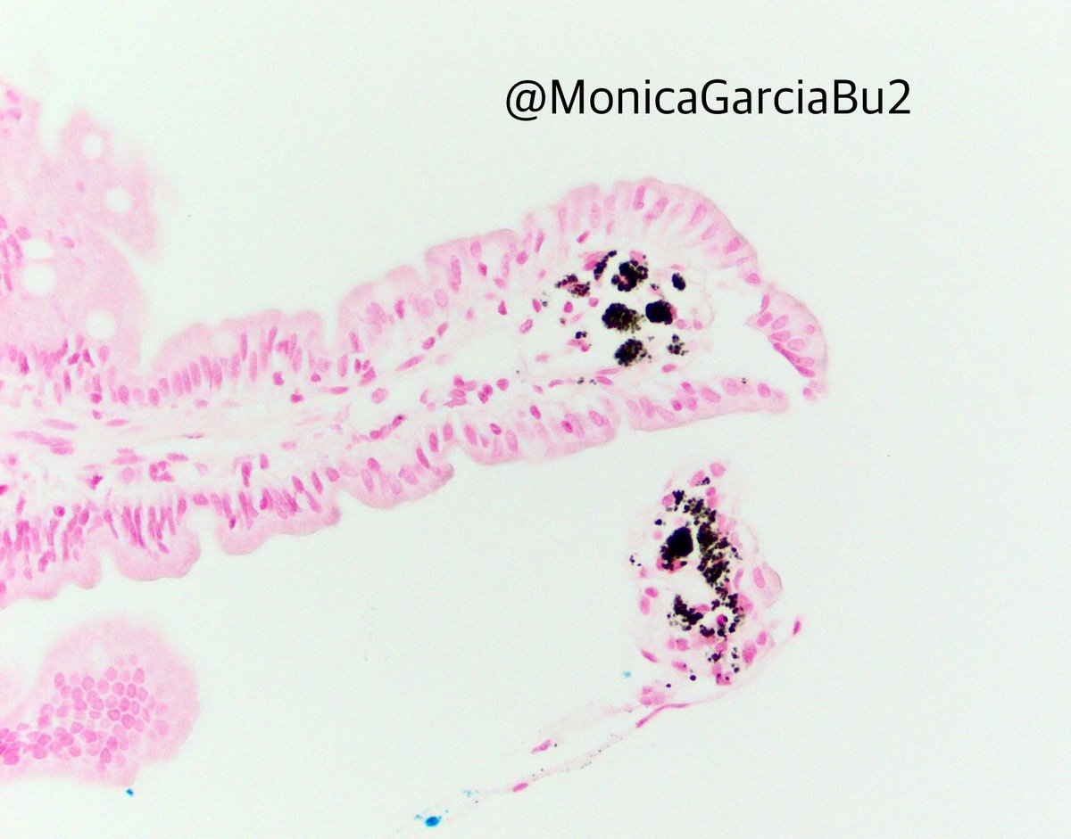 MonicaGarciaBuitrago (@monicagarciabu2) on Twitter photo Black speckled duodenum-mystery solved! 🎩
Pseudomelanosis duodeni: linked to HTN, CKD, DM, hemorrhage & sulfur-containing meds (thiazides, furosemide, BBs, hydralazine). Pigment is iron sulfide. Iron stain: neg.
#GIPath #PathTwitter #Endoscopy. <a href="/UMiamiPathology/">UMiami Pathology</a> <a href="/AmerGastroAssn/">American Gastroenterological Association (AGA)</a> Black speckled duodenum-mystery solved! 🎩
Pseudomelanosis duodeni: linked to HTN, CKD, DM, hemorrhage & sulfur-containing meds (thiazides, furosemide, BBs, hydralazine). Pigment is iron sulfide. Iron stain: neg.
#GIPath #PathTwitter #Endoscopy. <a href="/UMiamiPathology/">UMiami Pathology</a> <a href="/AmerGastroAssn/">American Gastroenterological Association (AGA)</a>