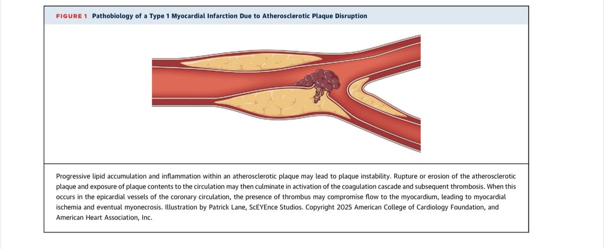 📌 ¿#Troponinas “porque sí”? ¿Cada 30 min, cada turno?? o cada quien según su el adscritosaurio?

👇🏽🔻 ¡Aquí te explico cómo sí se deben pedir según la guía!🧪🫀

📍 La troponina (cTn) es el biomarcador principal para detectar lesión miocárdica, y las pruebas de alta sensibilidad