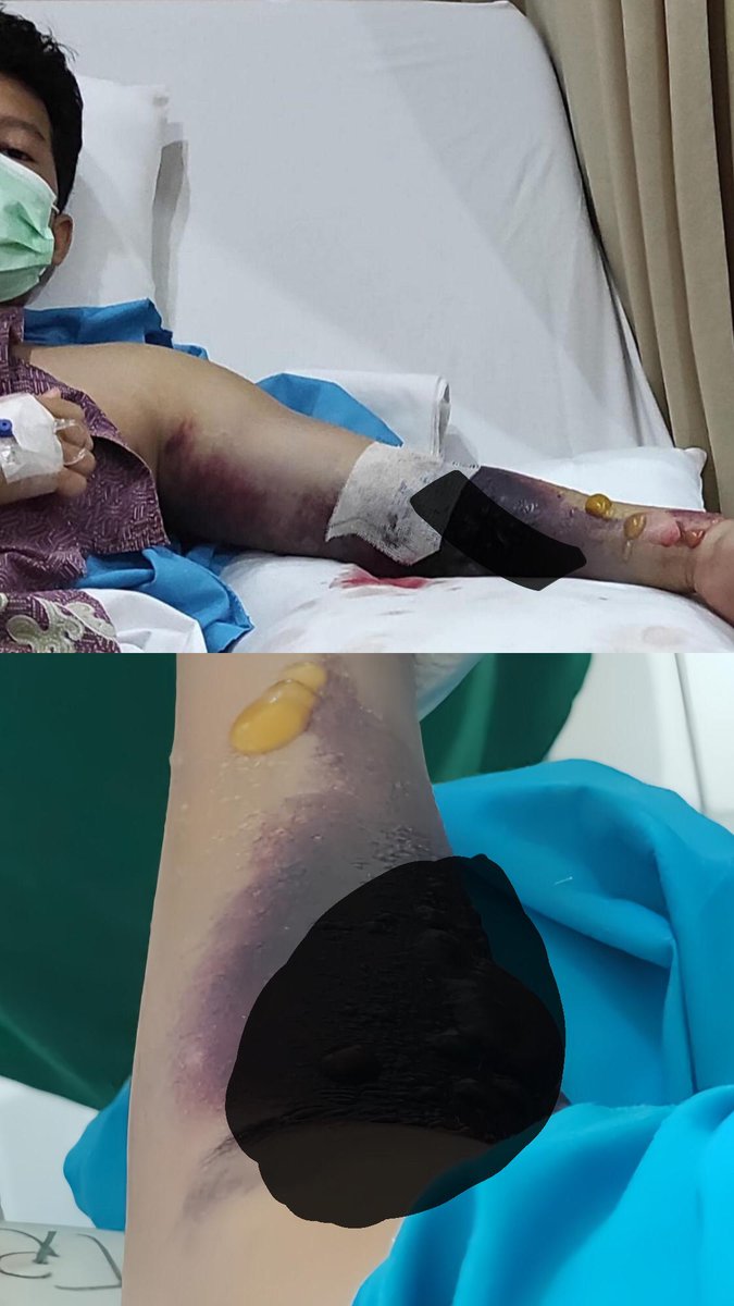 F4rizfirmansyah's tweet photo. TEMAN2 TOLONG BANTU VIRALKAN KASUS INI‼️ SAYA KORBAN DUGAAN MALPRAKTIK, RS TERKENAL KOTA BEKASI BUAT TANGAN SAYA CACAT!

Dirawat karena DBD, riwayat disuntik berulang di tempat yang sama. masih juga dibilang “risiko medis” ?? Sudah 3 tahun saya berjuang, tapi belum ada keadilan. https://t.co/nha8OwzkDK