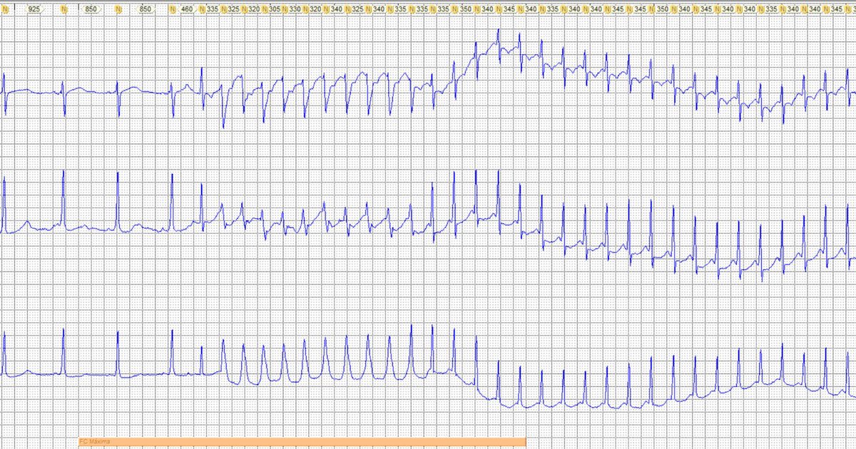 Antonio Thomaz de Andrade, MD 🇧🇷 (@athomazandrade) on Twitter photo 40-year-old woman with palpitations. What is the most likely diagnosis? <a href="/ecgandrhythmRoe/">Andreas Roeschl, MD</a> <a href="/ecgrhythms/">Arnel Carmona</a> <a href="/DidlakeDW/">David Didlake</a> <a href="/The_Nanashi_O/">Nanashī🫀</a> <a href="/KostekMilan/">Milan Koštek</a> <a href="/lucasmouraeef/">Lucas Moura</a> <a href="/Arron_Pearce_/">Arron Pearce</a> 40-year-old woman with palpitations. What is the most likely diagnosis? <a href="/ecgandrhythmRoe/">Andreas Roeschl, MD</a> <a href="/ecgrhythms/">Arnel Carmona</a> <a href="/DidlakeDW/">David Didlake</a> <a href="/The_Nanashi_O/">Nanashī🫀</a> <a href="/KostekMilan/">Milan Koštek</a> <a href="/lucasmouraeef/">Lucas Moura</a> <a href="/Arron_Pearce_/">Arron Pearce</a>