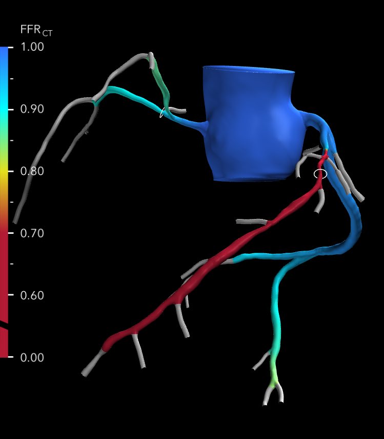 Manish Motwani (@doc_tiger) on Twitter photo Ok, enough UV ☀️🕶️….time to go indoors for some #YesCCT <a href="/escardio/">European Society of Cardiology</a> - EACVI cardiac CT course - the best exam prep in the world (probably) #photons Ok, enough UV ☀️🕶️….time to go indoors for some #YesCCT <a href="/escardio/">European Society of Cardiology</a> - EACVI cardiac CT course - the best exam prep in the world (probably) #photons