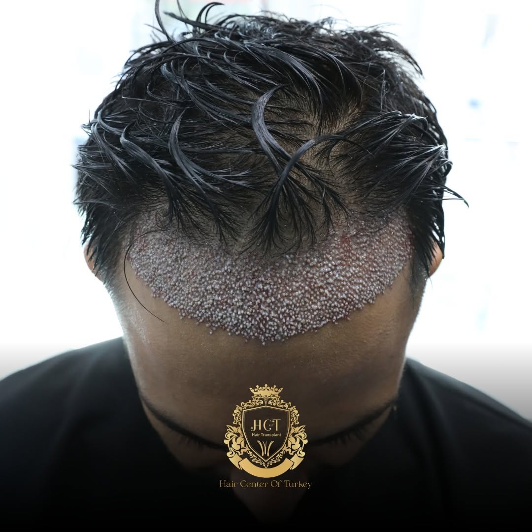 HairCenterOfTur's tweet photo. Here is one of our patient who had hair transplant with us using Sapphire FUE method, 2500 grafts transplanted.

We use a new technique without shaving the hair. You can look same as before the hair transplant surgery!

#hairtransformation
#hairtransplant
#hairtransplantistanbul
#hairtransplantturkey
#cosmeticsurgery
#plasticsurgery
#hair
#hairtutorial
#hairtransformation
#hairline